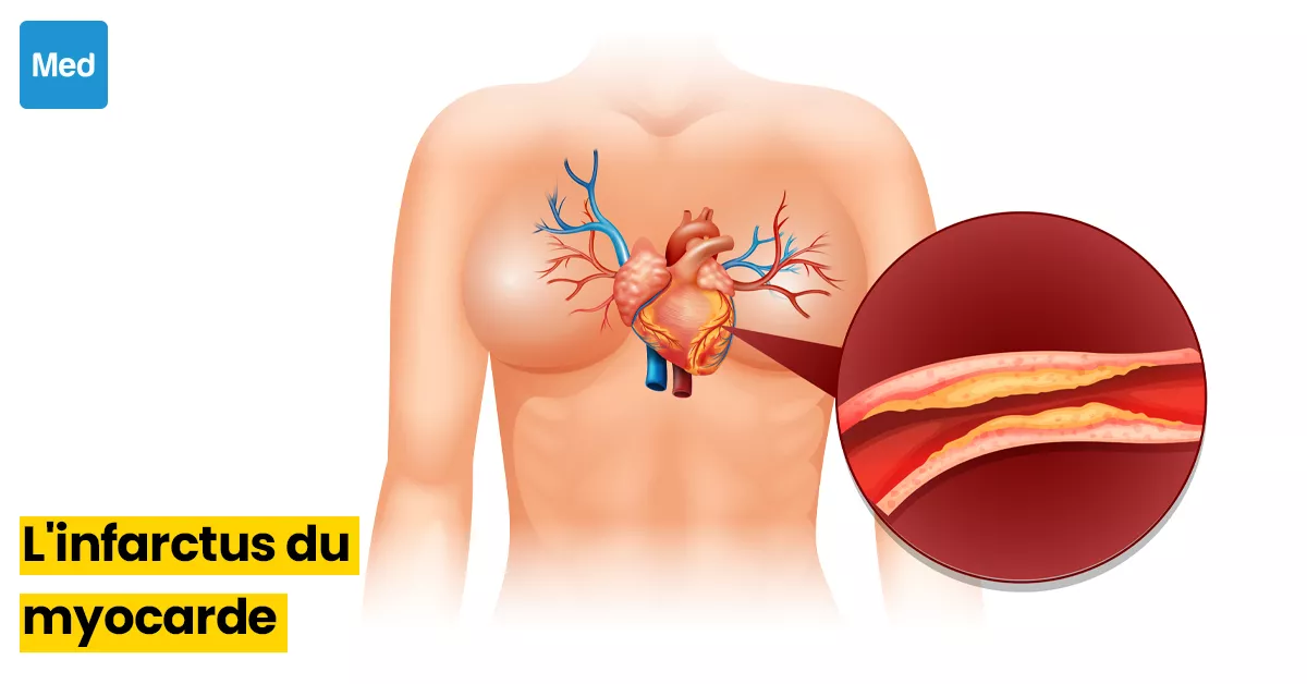  Tout ce que vous devez savoir sur l'infarctus du myocarde : Symptômes, facteurs de risque et prévention